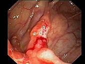 Crohn's disease, endoscope view