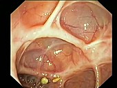 Scars in the colon, endoscope view
