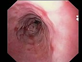 Oesophagitis, endoscope view