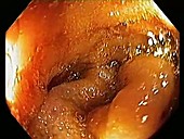 Large intestine, endoscope view