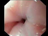 Patch of abnormal oesophageal cells