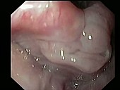 Larynx, endoscope view