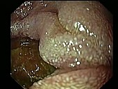 Diverticulosis, endoscope view