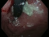 Stomach cancer, endoscope view