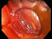Stained colon, endoscope view