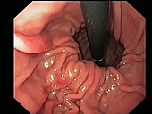 Hiatus hernia, endoscope view