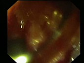 Duodenal ulcer, endoscope view