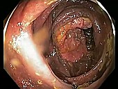 Caecal cancer, endoscope view