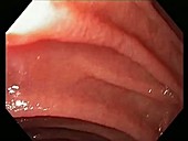 Duodenum, endoscope view