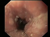 Oesophageal papillomatosis endoscope view