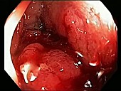 Bleeding rectal cancer, endoscope view