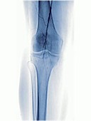 Leg angiography