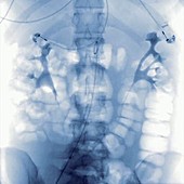 Kidney aneurysm, angiography