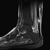 Torn Achilles tendon, MRI scan