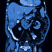 Gallstones, CT scan