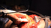 Pancreatic cancer surgery