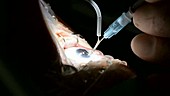 Cataract surgery