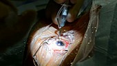 Cataract surgery