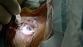 Cataract surgery