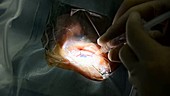 Cataract surgery