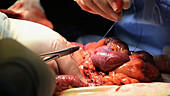 Bowel cancer surgery