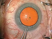 Cataract surgery