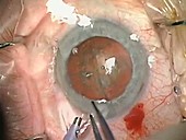 Cataract surgery