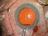 Cataract surgery