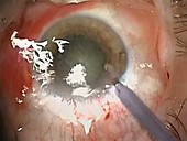 Cataract surgery