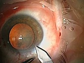 Cataract surgery