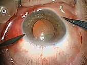 Cataract surgery