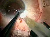 Cataract surgery