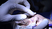 Skin cancer nose surgery, incision lines