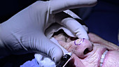 Skin cancer nose surgery, anaesthetic
