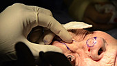 Skin cancer nose surgery, anaesthetic