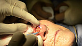 Skin cancer nose surgery, cauterization