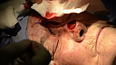 Skin cancer nose surgery, flap creation