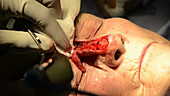 Skin cancer nose surgery, flap creation