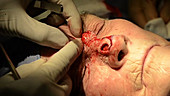 Skin cancer nose surgery, flap creation