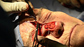 Skin cancer nose surgery, flap stitching