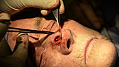 Skin cancer nose surgery, flap stitching