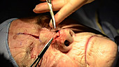 Skin cancer nose surgery, flap stitching