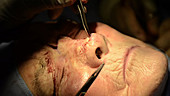 Skin cancer nose surgery, flap stitching