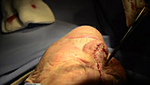 Skin cancer nose surgery, flap stitching