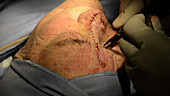 Skin cancer nose surgery, flap stitching