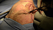 Skin cancer nose surgery, flap stitching