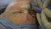 Skin cancer nose surgery, taping wound