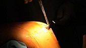 Partial knee replacement surgery