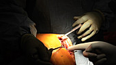 Partial knee replacement surgery