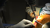 Partial knee replacement surgery